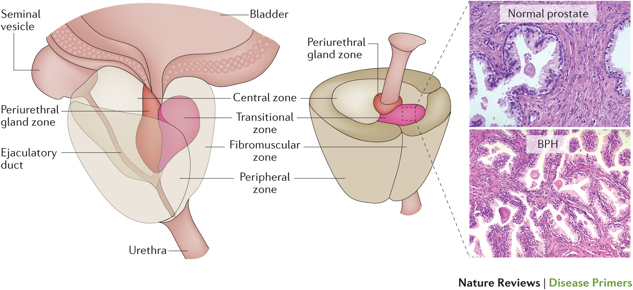 prostatitis hiperplázia)