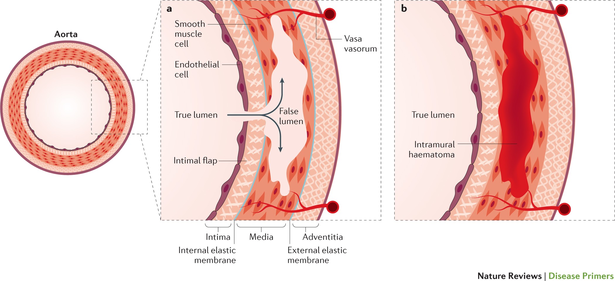 Aortic Dissection Nature Reviews Disease Primers