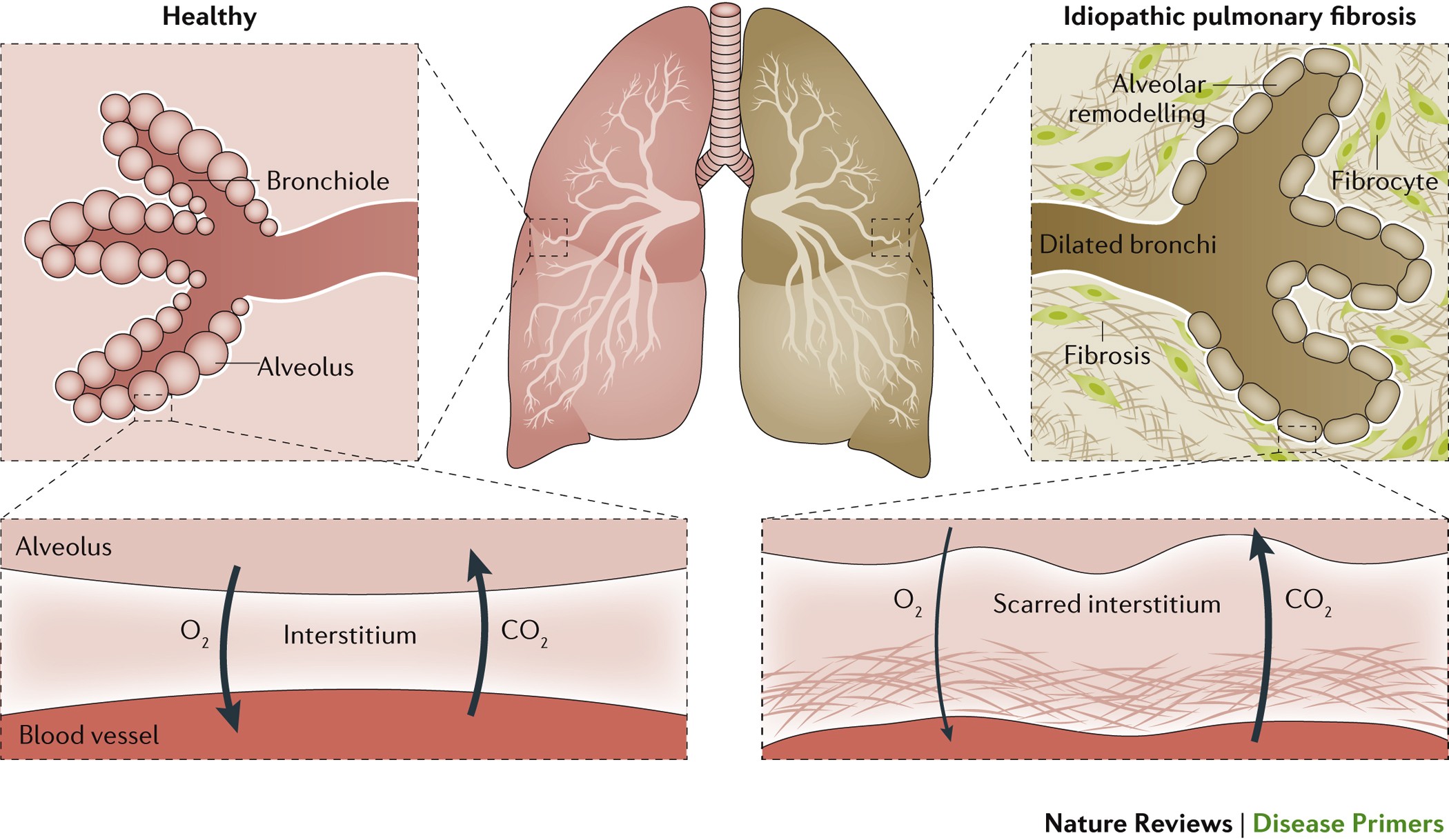 Image result for lung fibrosis