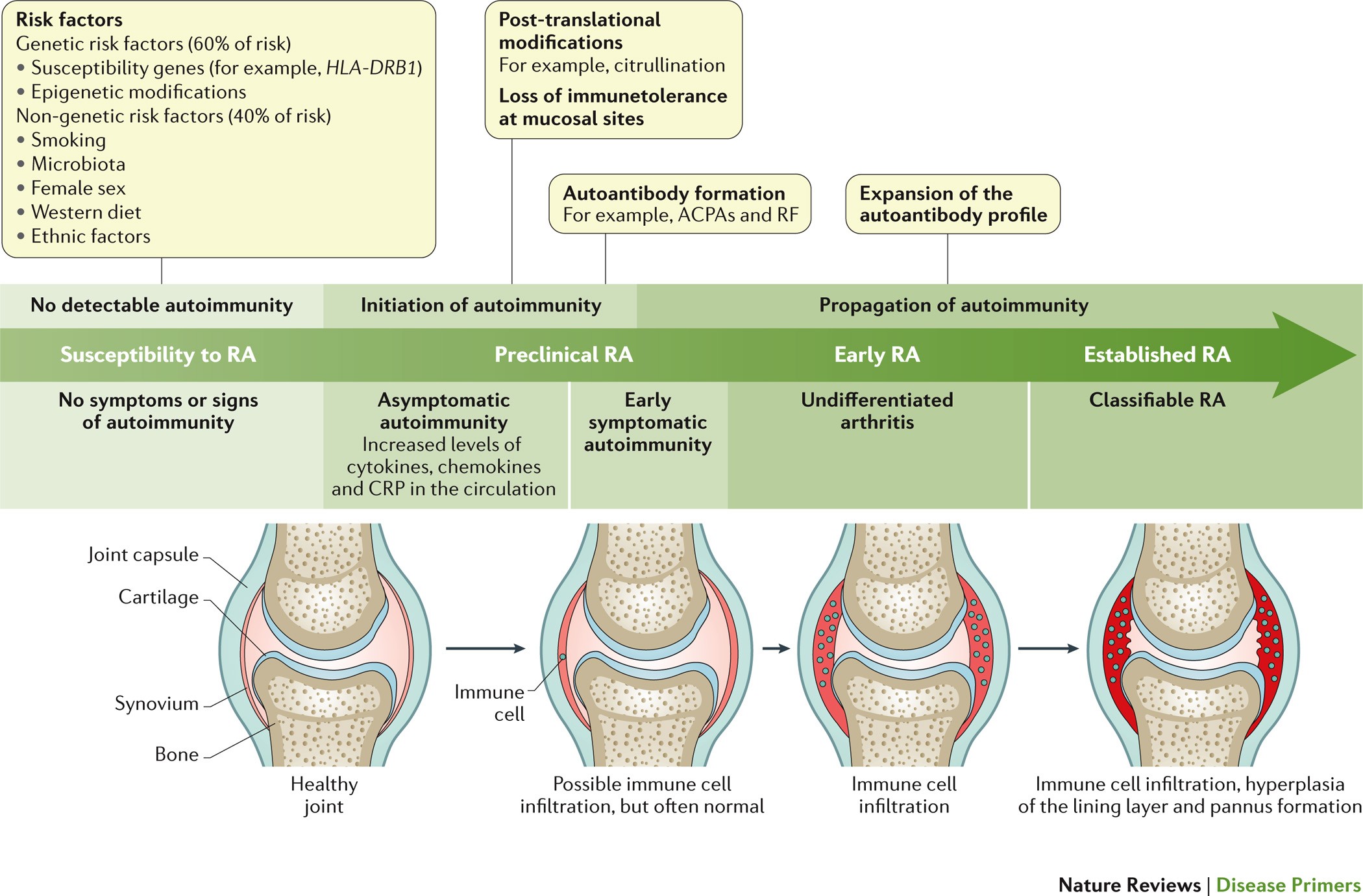 Rheumatoid arthritis pathogenesis review, Ízületi károsodás jelei