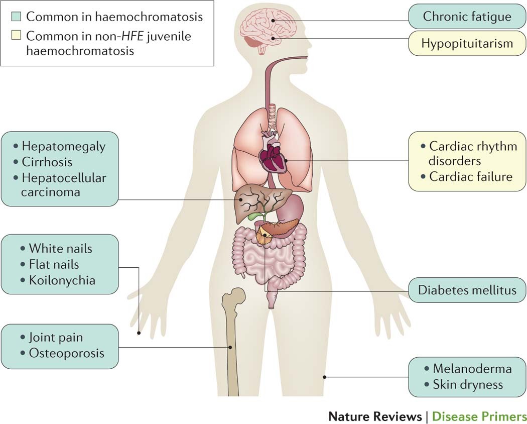 Hemochromatosis Chart