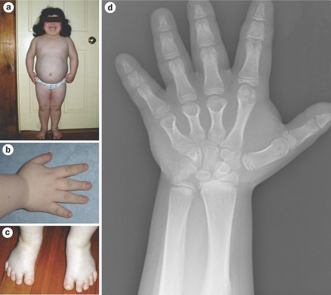 Pseudohypoparathyroidism type 1a and insulin resistance in a child