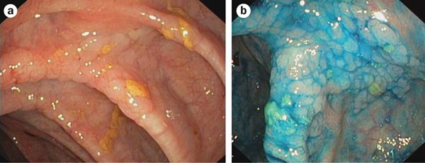 Endoscopic and pathological aspects of colitis-associated dysplasia |  Nature Reviews Gastroenterology & Hepatology