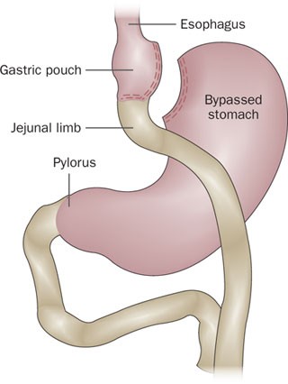 Managing Medical And Surgical Disorders After Divided Roux En Y Gastric Bypass Surgery Nature Reviews Gastroenterology Hepatology
