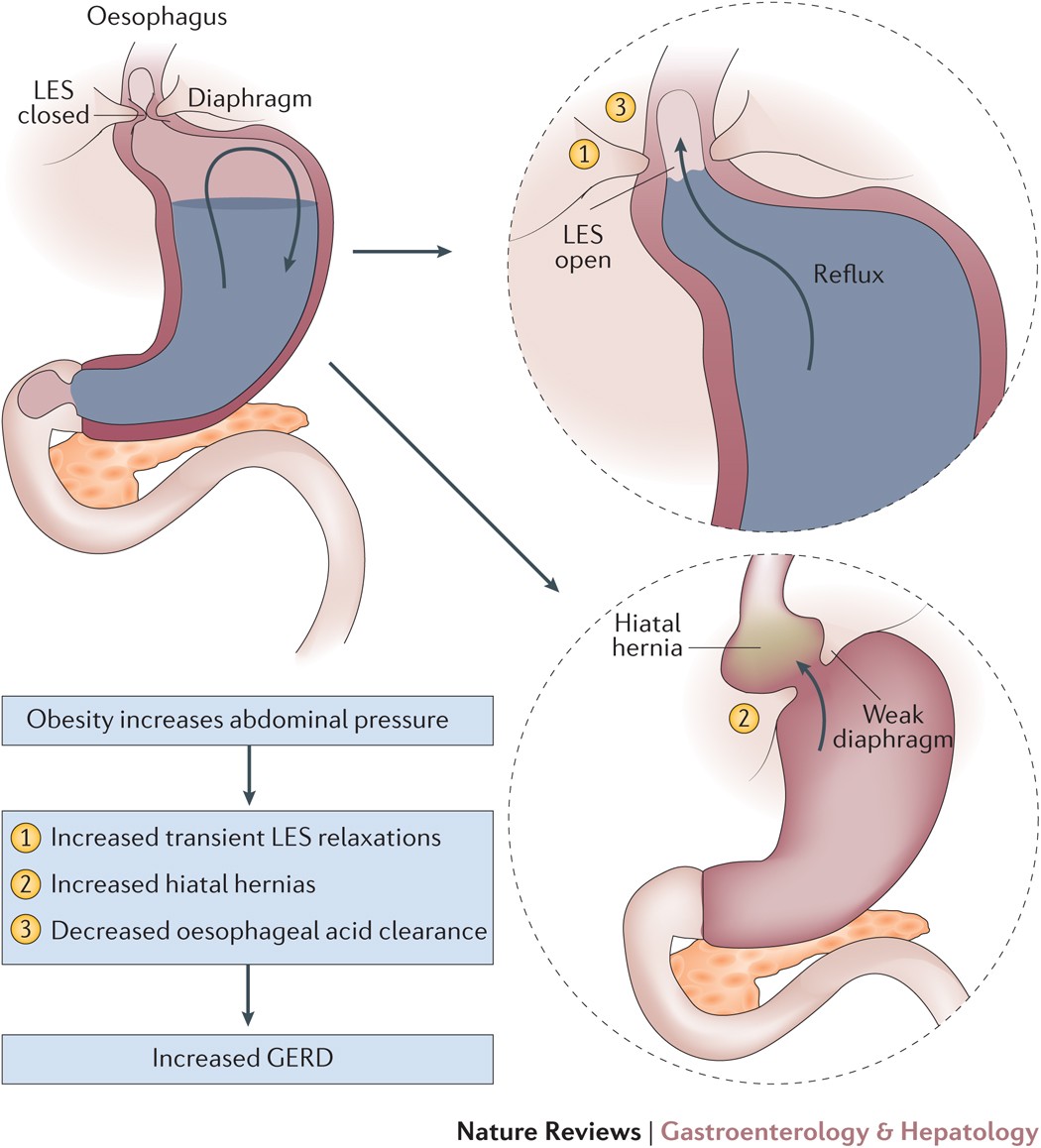 Gastric Band Surgery Perth | Lap Band Surgery | Weight Loss Surgeon