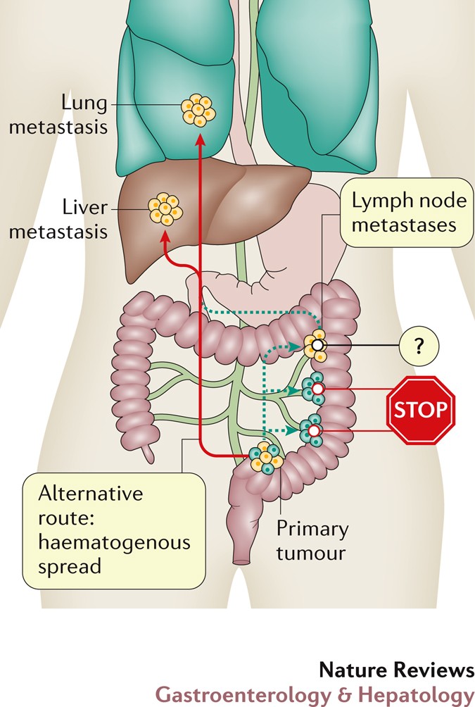 How fast does colon cancer spread