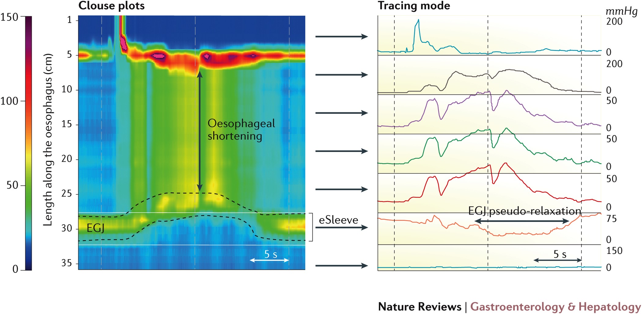 Advances In The Management Of Oesophageal Motility Disorders In The Era Of High Resolution Manometry A Focus On Achalasia Syndromes Nature Reviews Gastroenterology Hepatology