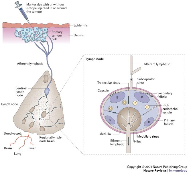 Active surveillance of patients who have sentinel node positive