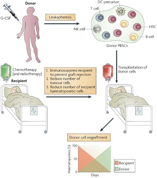 Unpacking Graft Versus Host Disease: Common Symptoms You Should Know - Risk Factors for Developing GVHD