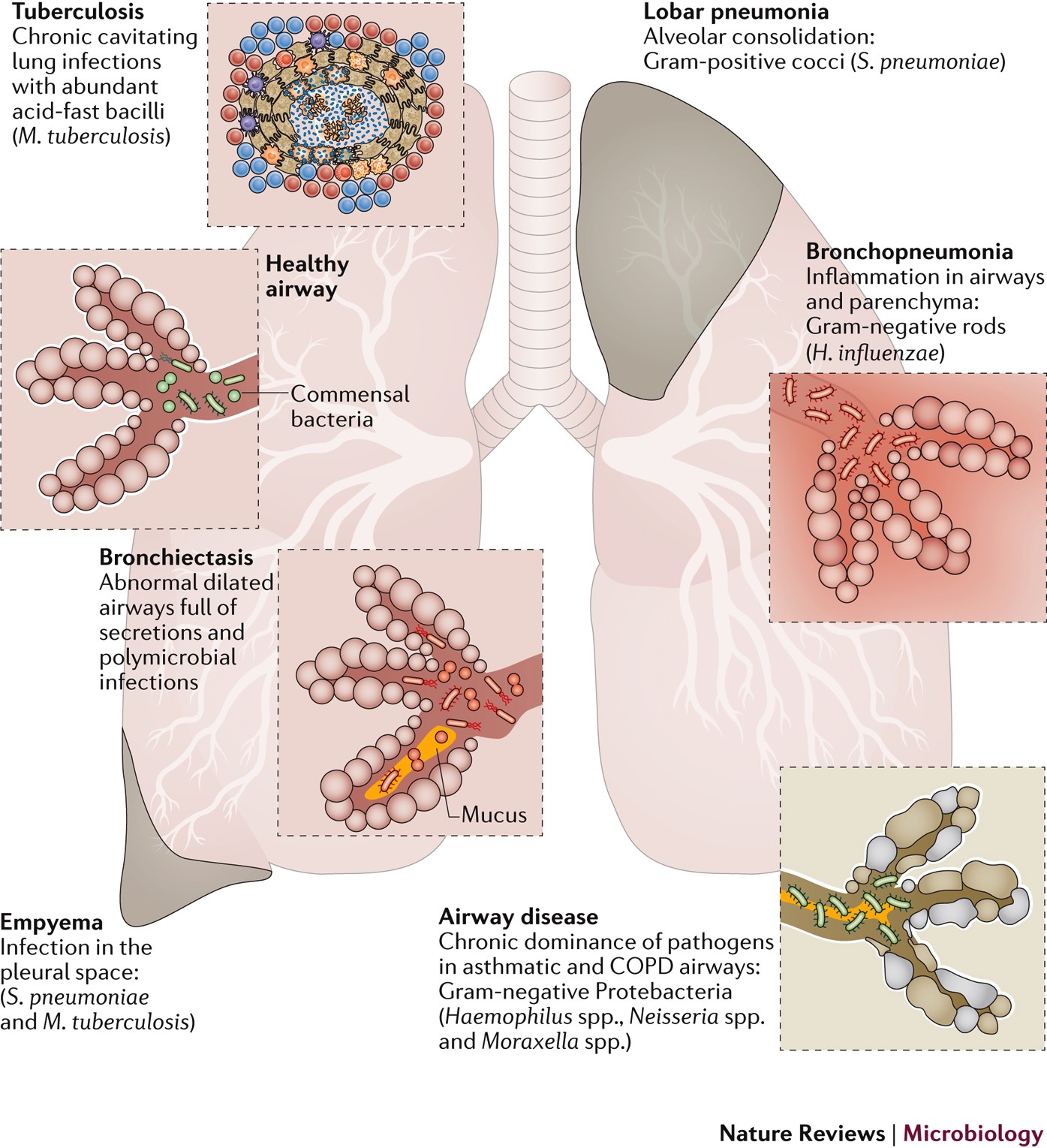 Bronchiectasis Patients Exhibit Higher Sedentary Life-Styles and