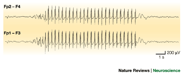 Childhood absence epilepsy: Genes, channels, neurons and networks | Nature  Reviews Neuroscience