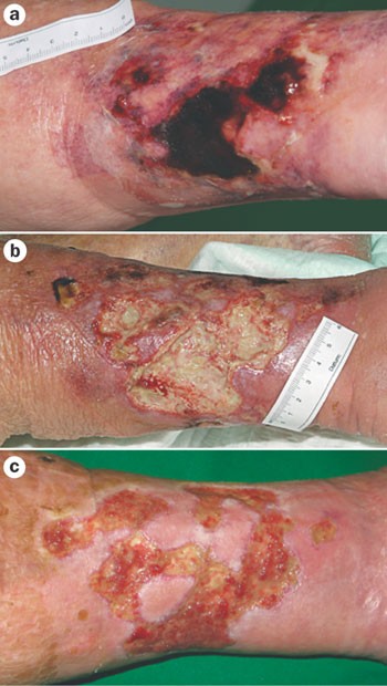 uremic calciphylaxis