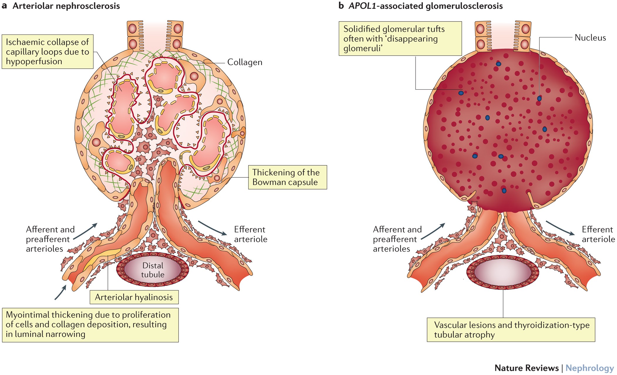 High blood pressure related kidney damage glomerulosclerosis comparison