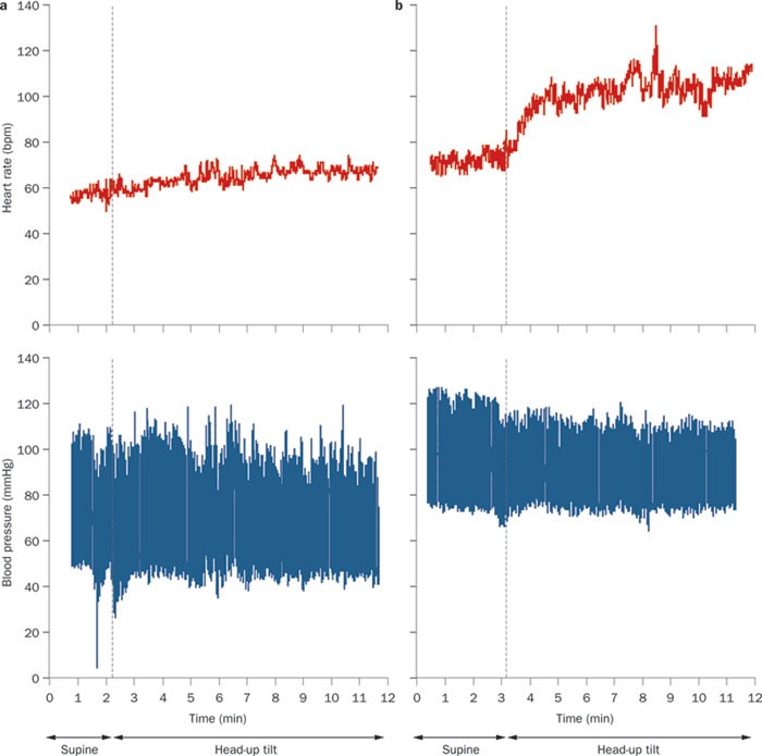 Postural orthostatic tachycardia syndrome (POTS) results in a sustained  increase in heart rate of at least 30 beats per minute in adults