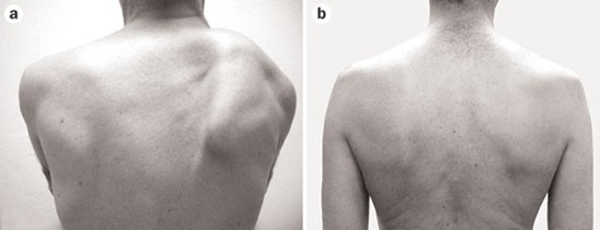 Clinical and pathophysiological concepts of neuralgic amyotrophy | Nature Reviews Neurology