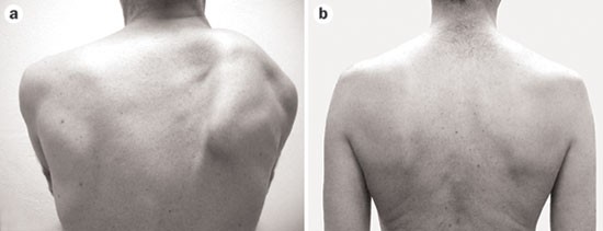 Clinical and pathophysiological concepts of neuralgic amyotrophy | Nature  Reviews Neurology