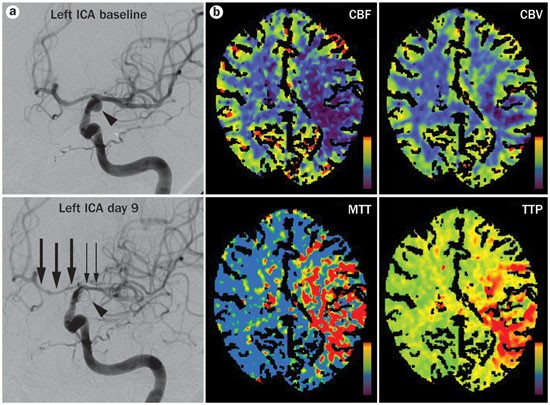 Subarachnoid Hemorrhage, Vasospasm, and Delayed Cerebral Ischemia -  Practical Neurology