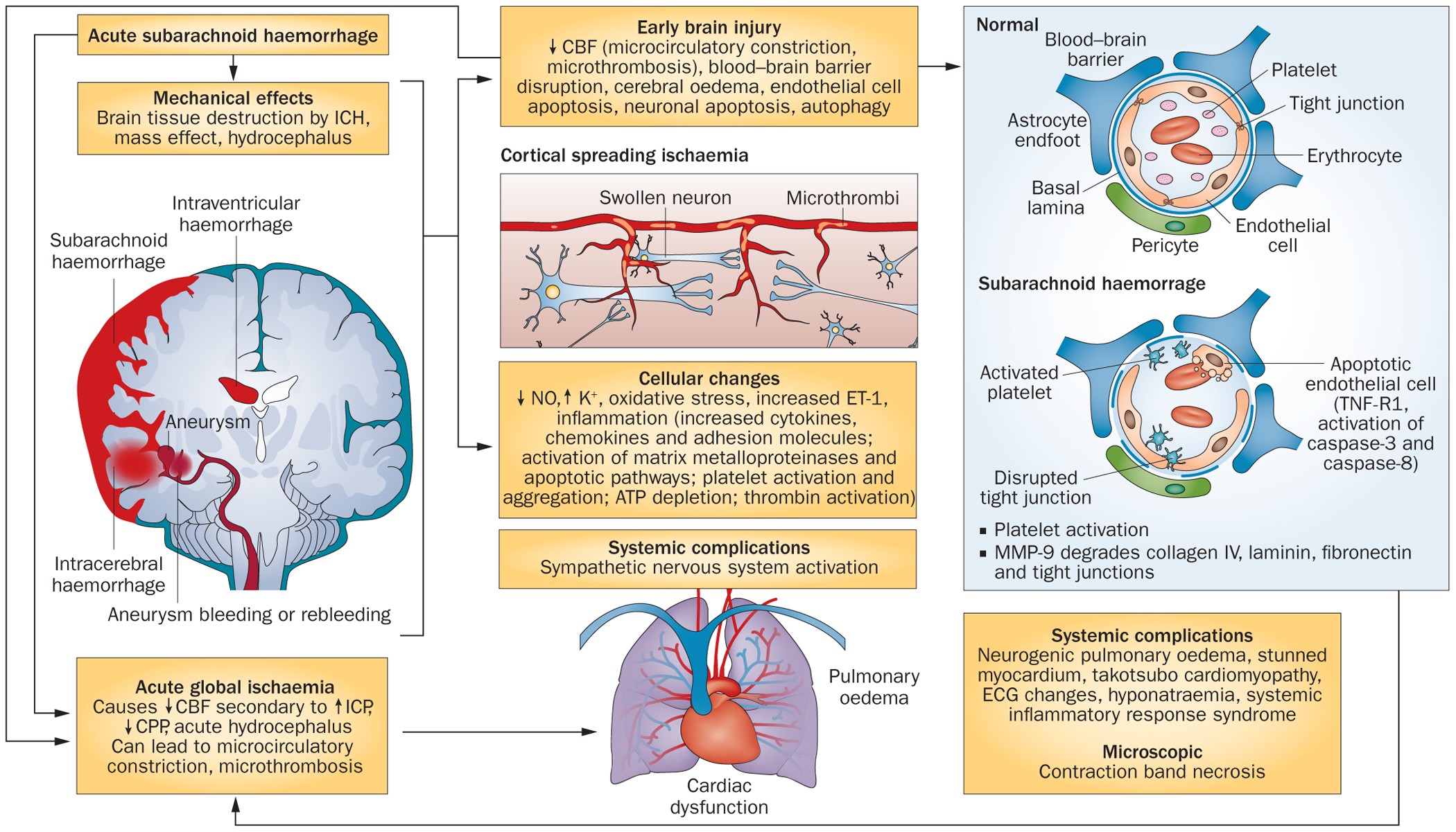 Subarachnoid Hemorrhage (SAH) - Trial Exhibits Inc.