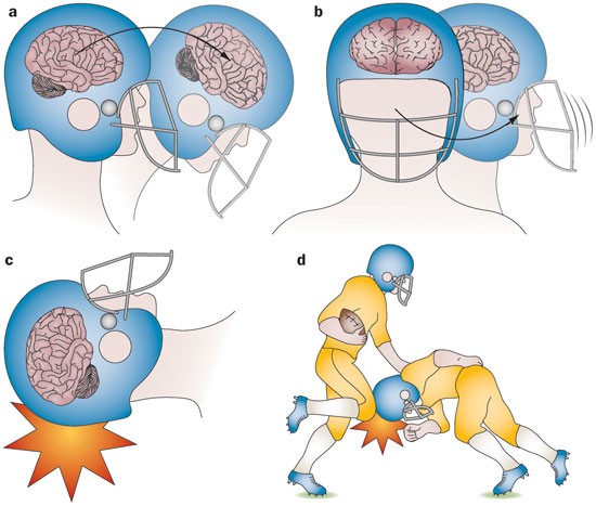 A Sport Where You Purposely Incur Head Injuries?