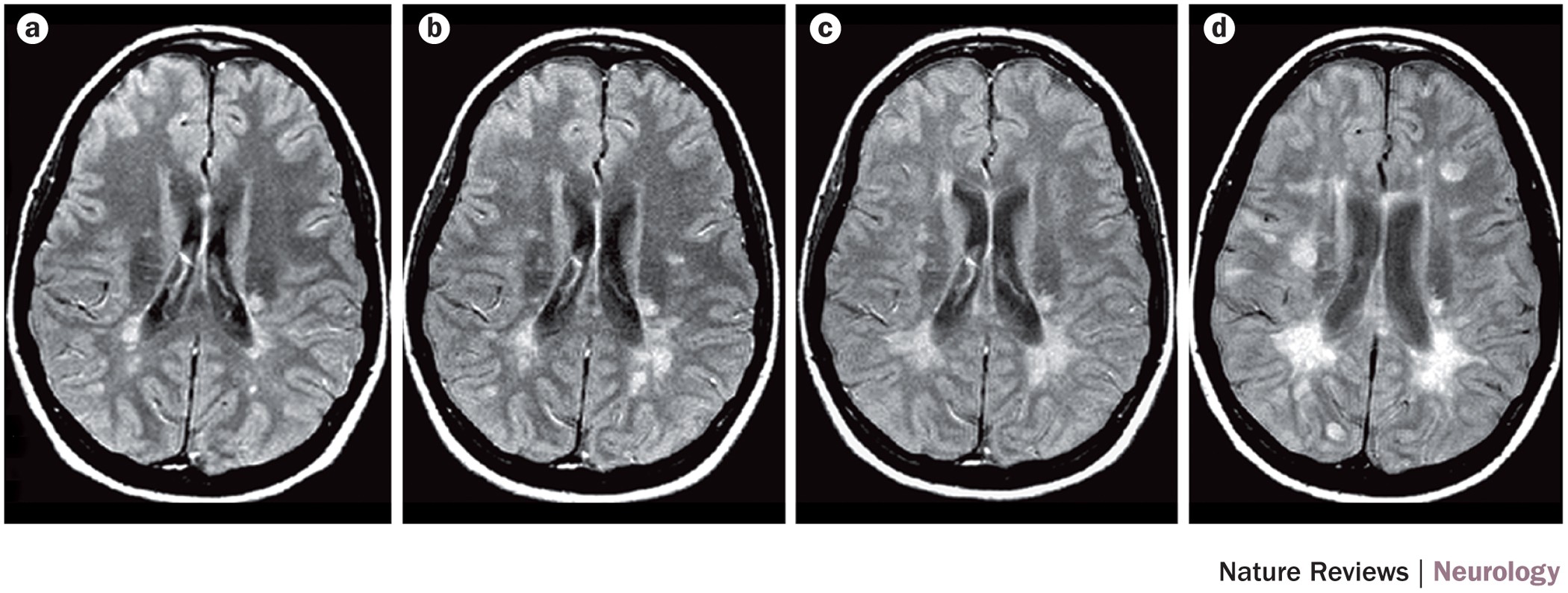 ms mri brain scan results