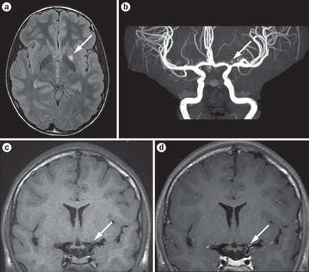 The spectrum of CNS vasculitis in children and adults | Nature Reviews  Rheumatology