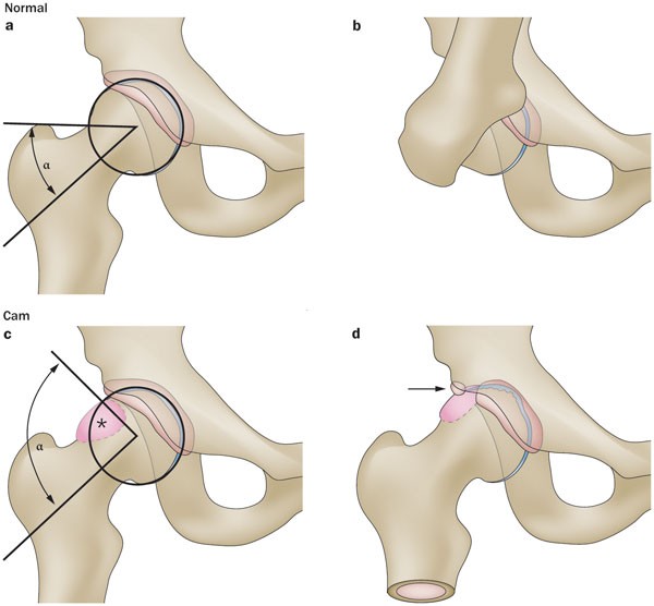 piedestal Mod Onkel eller Mister Cam impingement of the hip—a risk factor for hip osteoarthritis | Nature  Reviews Rheumatology
