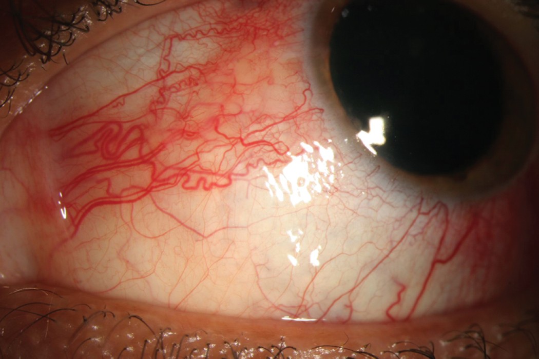 Ocular inflammatory diseases associated with rheumatoid arthritis | Nature Reviews Rheumatology