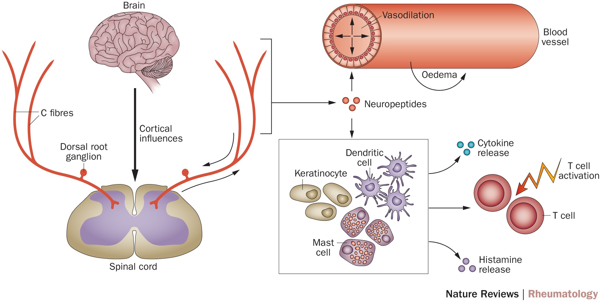 Neurogenic neuroinflammation in fibromyalgia and complex regional pain  syndrome | Nature Reviews Rheumatology
