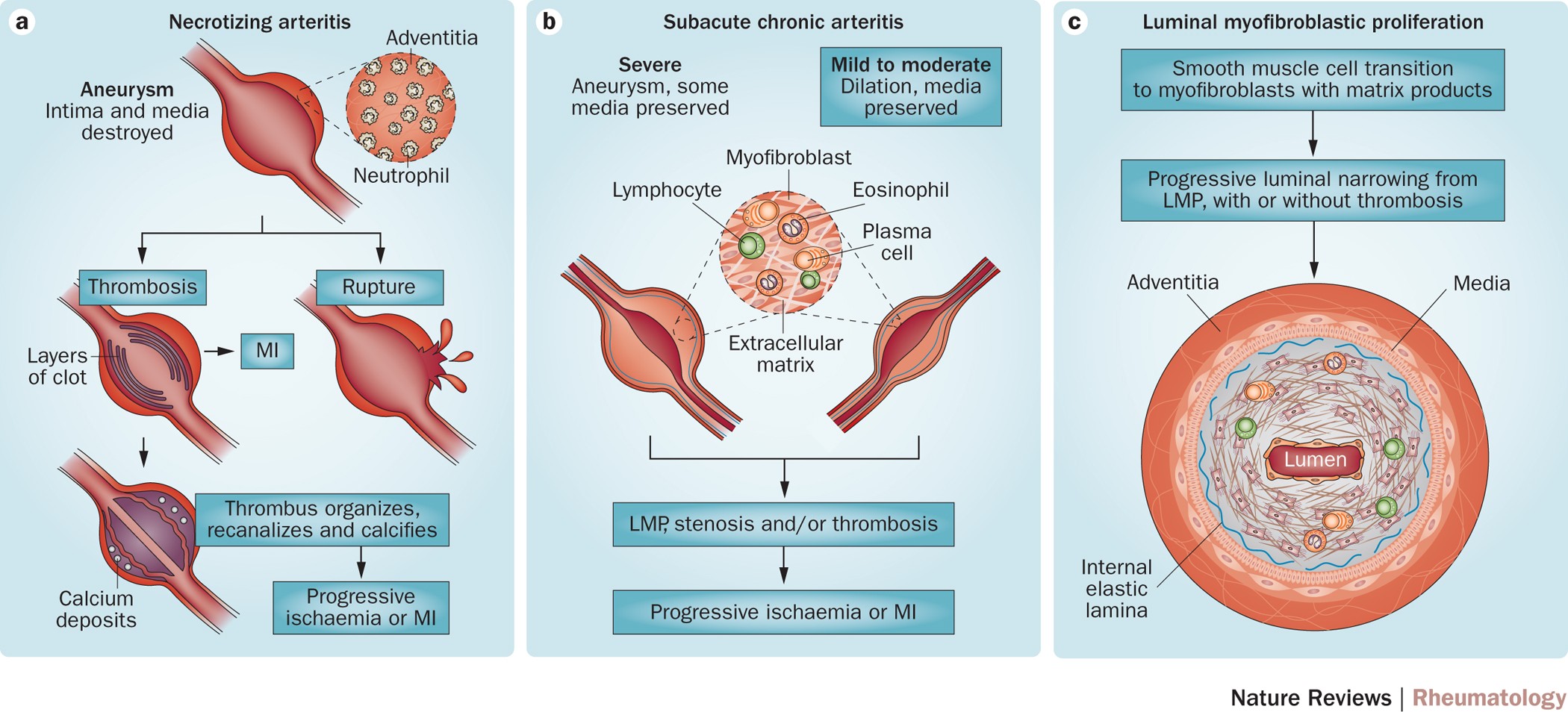 kawasaki arteritis