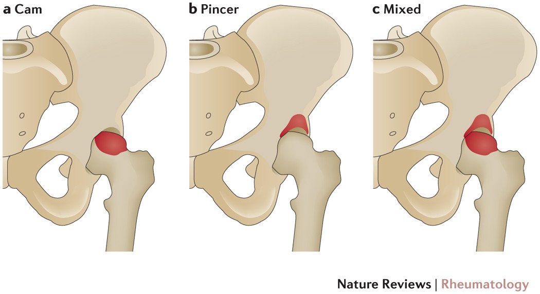 New perspectives on femoroacetabular impingement syndrome Nature Reviews
