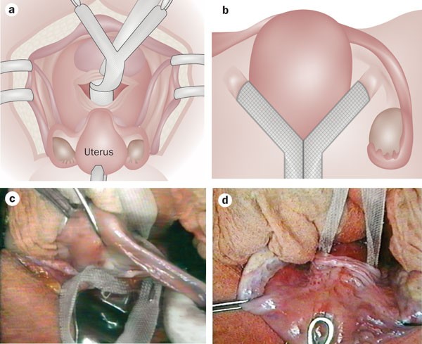 Uterus preservation in pelvic organ prolapse surgery