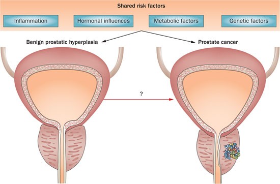 Adenom prostatic benign