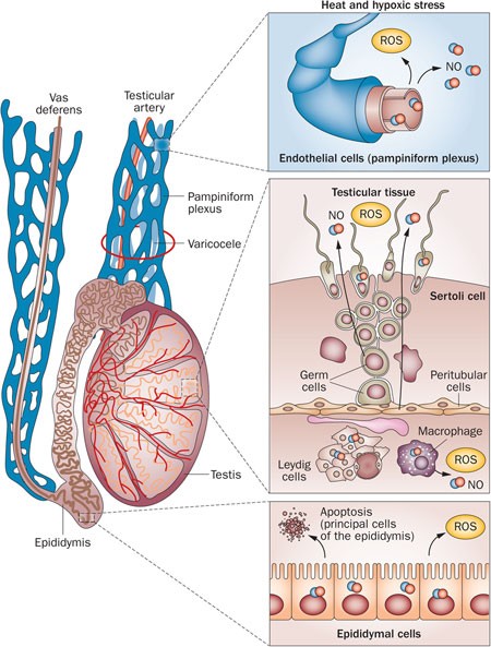 Insight into oxidative stress in varicocele-associated male infertility:  part 1