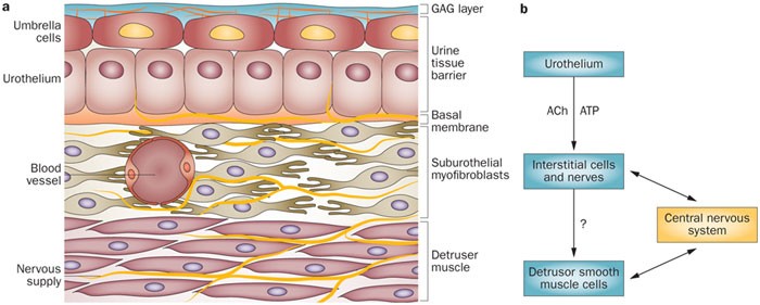 Intravesical treatments of bladder pain syndrome/interstitial