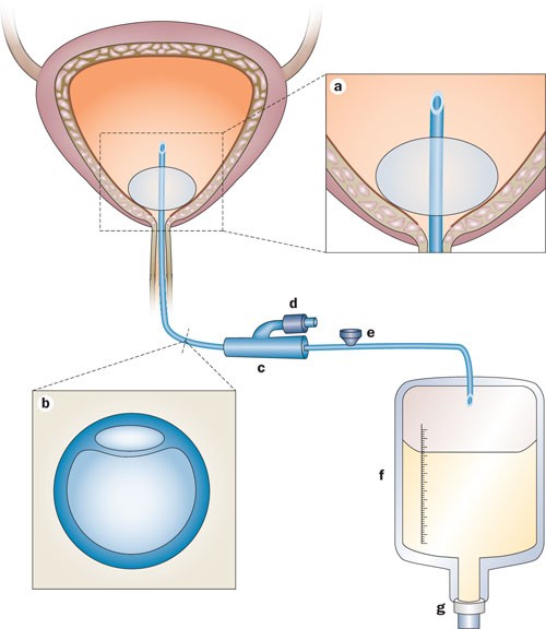 Urinary Flow Test  Steinberg Urology