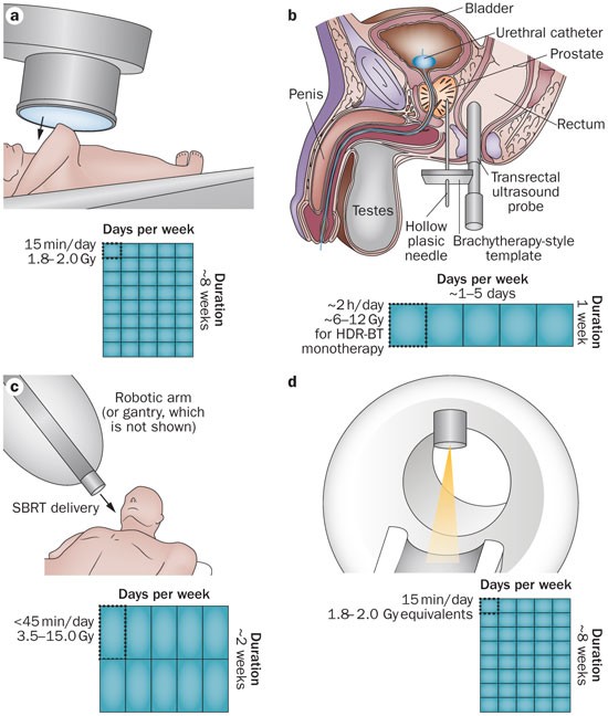 Evolution of advanced technologies in prostate cancer radiotherapy | Nature  Reviews Urology
