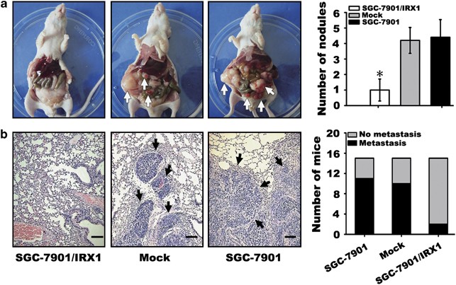 irx1-influences-peritoneal-spreading-and-metastasis-via-inhibiting-bdkrb2-dependent-neovascularization-on-gastric-cancer-oncogene