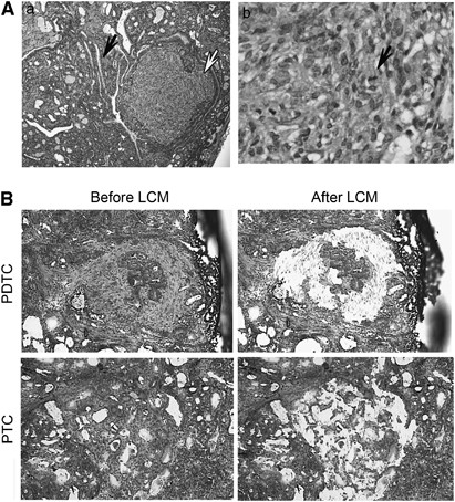 Progression Of Braf Induced Thyroid Cancer Is Associated With Epithelial Mesenchymal Transition Requiring Concomitant Map Kinase And Tgfb Signaling Oncogene