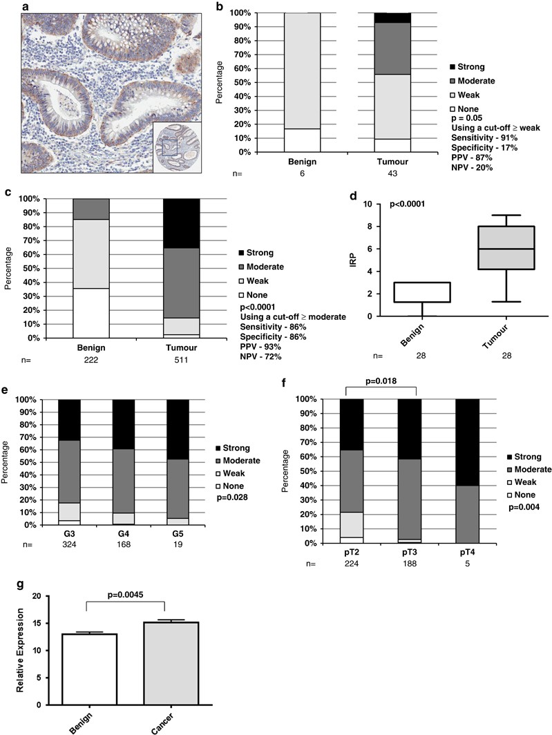 N Acetyl L Aspartyl L Glutamate Peptidase Like 2 Is Overexpressed In Cancer And Promotes A Pro Migratory And Pro Metastatic Phenotype Oncogene