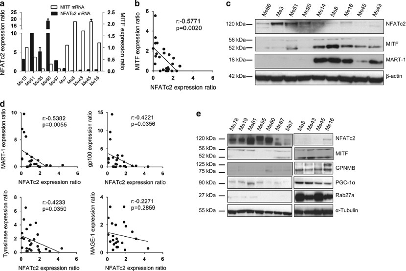 voordeel beschaving breuk NFATc2 is an intrinsic regulator of melanoma dedifferentiation | Oncogene