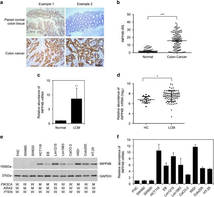 INPP4B is an oncogenic regulator in human colon cancer | Oncogene