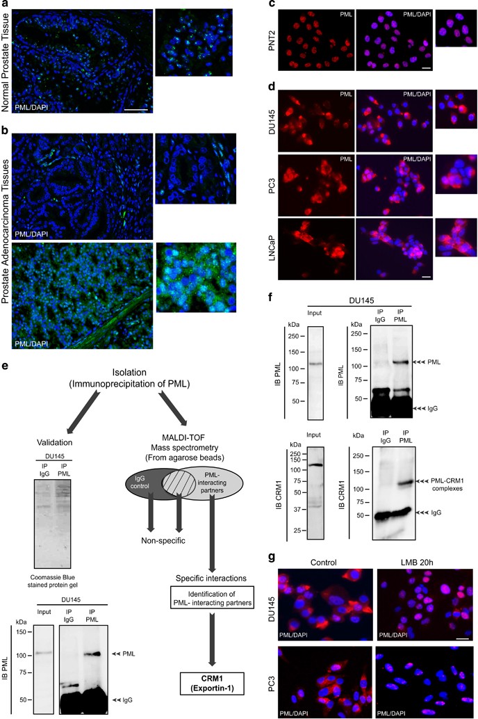 promotes ... Cytoplasmic TGF-β-associated PML epithelial ... TGF-β-associated epithelial PML promotes Cytoplasmic