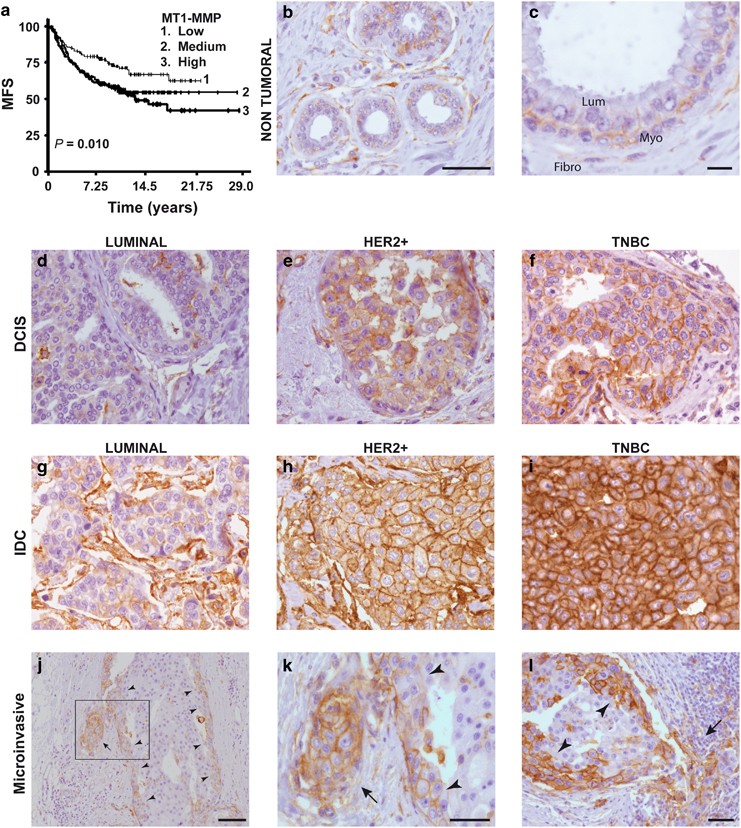 p63/MT1-MMP axis is required for in situ to invasive transition in  basal-like breast cancer | Oncogene