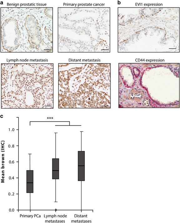 Ecotropic viral integration site 1, a novel oncogene in prostate cancer |  Oncogene