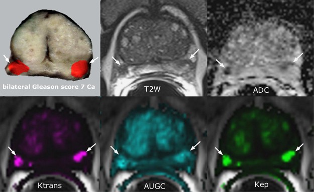 multiparametric prostate mri with contrast