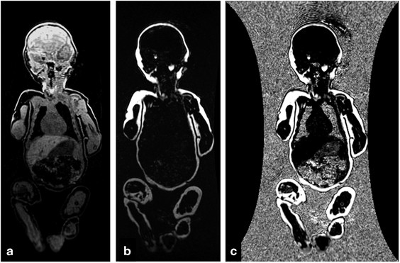 High-resolution rapid neonatal whole-body composition using 3.0 Tesla  chemical shift magnetic resonance imaging | Pediatric Research
