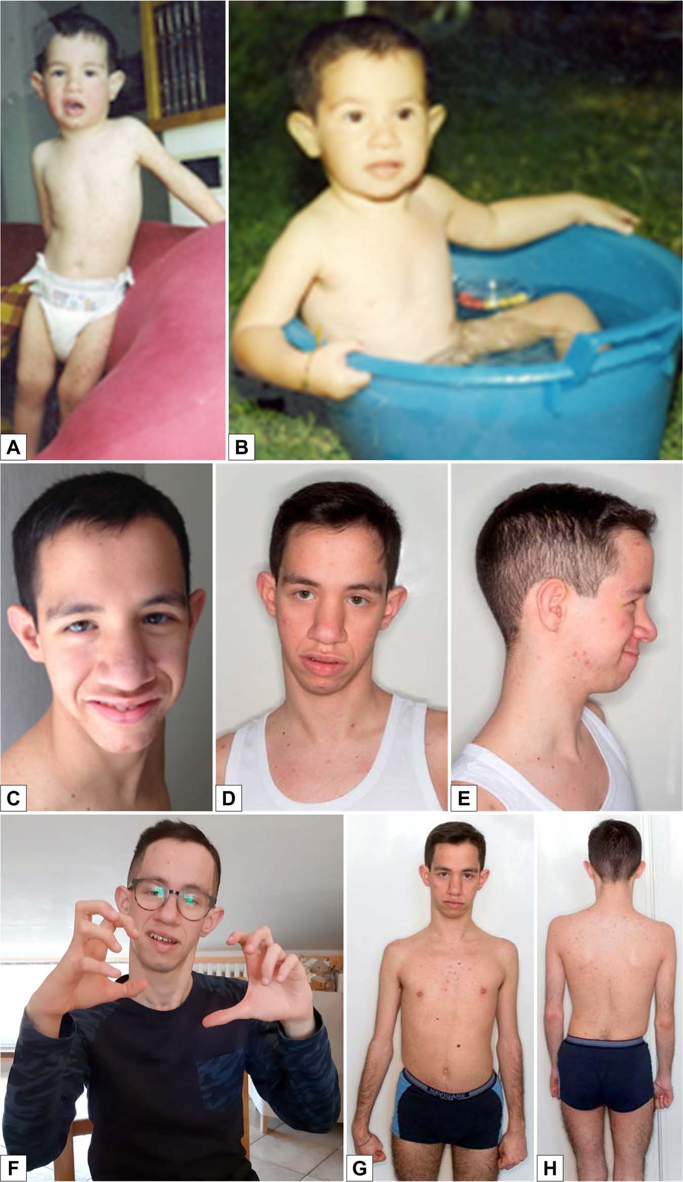 Alazami syndrome: the first case of papillary thyroid carcinoma | Journal  of Human Genetics