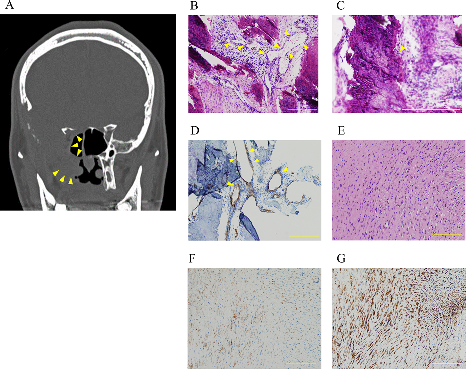 (PDF) Identification of de novo EP300 and PLAU variants in a patient with  Rubinstein–Taybi syndrome-related arterial vasculopathy and skeletal anomaly