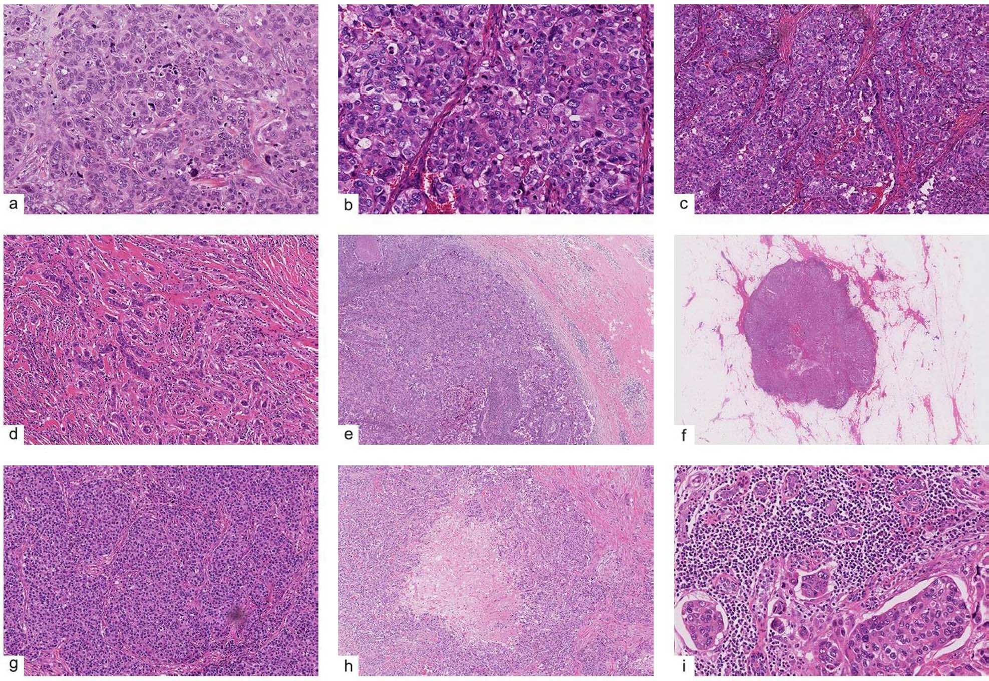 loss of brca1 expression and morphological features associated with brca1 promoter methylation status in triple negative breast cancer journal of human genetics