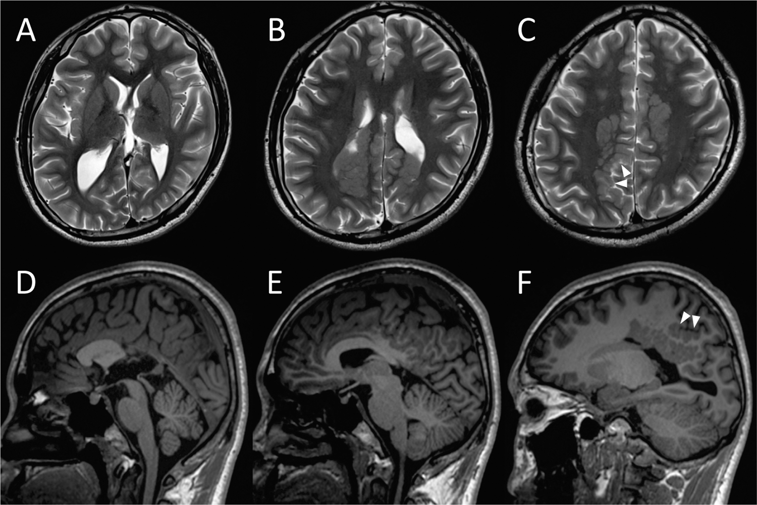 Clinical and mutational spectrum in Korean patients with Rubinstein–Taybi  syndrome: The spectrum of brain MRI abnormalities - ScienceDirect